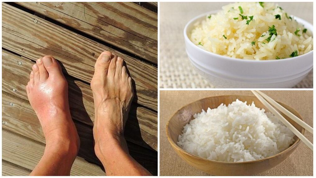 Μια δίαιτα με βάση το ρύζι συνιστάται για ασθενείς με ουρική αρθρίτιδα. 